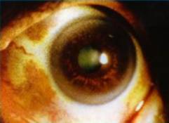 Occular Melanosis